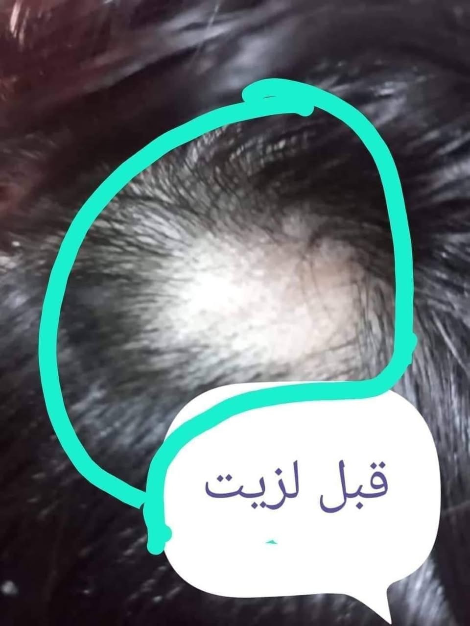 خلال سبوعين سبوعين لااكثر إذا مصار شعرج هيج أن بلخدمه
يطول شعر بشكل فضيع 😍✌️🏻

يمنعلج التساقط 

يكثف شعرج 

وينعمه ويلمعه شتريدين بعد أكثر سندوسه😉💜

يصير شعرج بطولج بالله العظيم 😍✌️🏻   دخذي واحد والثاني كد ماراح يعجبج الزيت غصب عليج راح ترجعين وتشترينه مني 🙊🥺😍وتوصيل لجميع محفظات 🚗🔥 بقيه البيجات عزلوا احسسلكم👍🏻❌

تعاي خاص ومعليج بل باقي توصيل جميع لمحفظات موجود لحجز ع خاص امنت الله ورسوله زيت مجرب وجربت ع شعري ومشالله نصحكم بيه كلش تاخذي تدعلي شرط ولله علفرق يشهدلله يجننن يجننن


**إذا كنت صاحب هذا الإعلان وتريد حذفه لأي سبب، رجاءا أرسل رسالة إلى الدعم الفني**