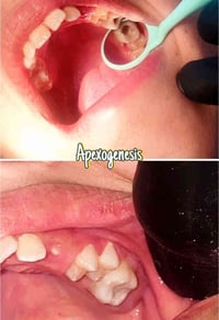 حشوات ضوئيه • اعادة تفاصيل السن • مجمع اليمامه التخصصي