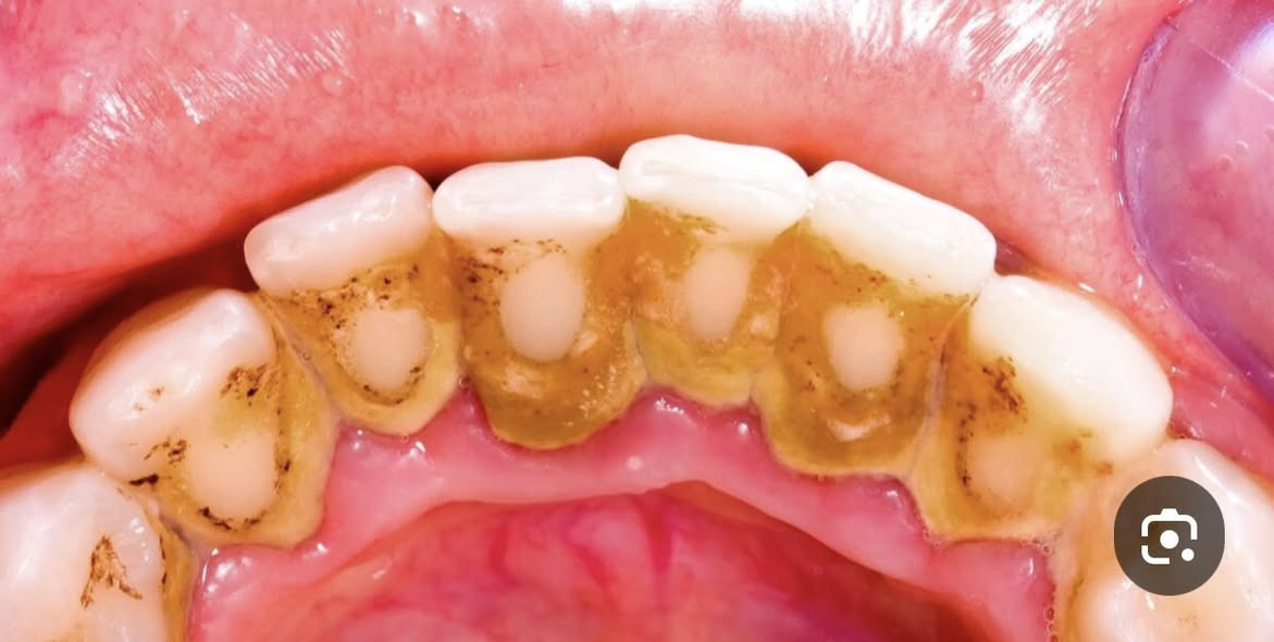 تنظيف اسنان مجاني للاسنان الي مثل الصور في البصرة والزبير للتواصل ***********
