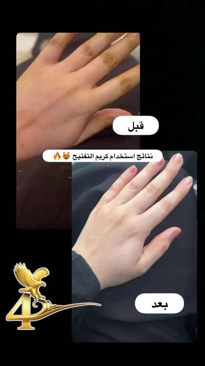 💬 “من كم استخدام بس… لون إيدي فتح وصار ناعم بشكل يجنن 😍”


**إذا كنت صاحب هذا الإعلان وتريد حذفه لأي سبب، رجاءا أرسل رسالة إلى الدعم الفني**