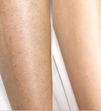 جهاز ليزر • مقشر ومرطب • توصيل مجاني