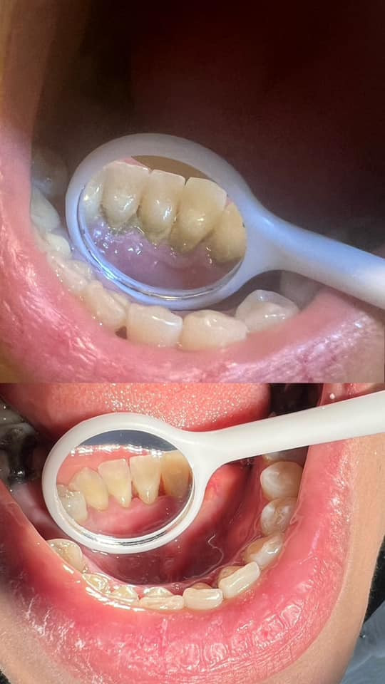 السلام عليكم طالبة طب اسنان مرحلة رابعة الاسبوع القادم نبلش شغل بعيادات اللي محتاج :
١_قلع الاسنان التالفة وبقايا الجذور 
٢_تنظيف الأسنان وازالة التكلسات والتصبغات
العلاج مجاني فقط حساب الوصل 
يتم العلاج تحت إشراف اطباء أختصاص ✅

العنوان/ الرمادي / جامعة المعارف 

للتواصل واتساب ***********
