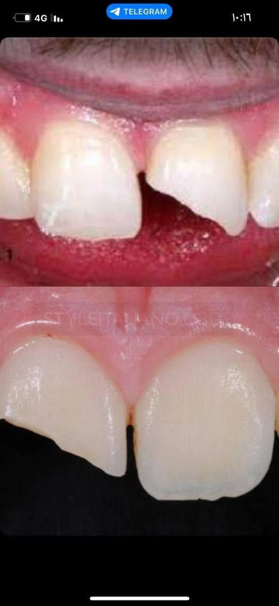 السلام عليكم
تنويه 🔔
يتوفر لدينا تنظيف اسنان وقلع وحشوات تحت إشراف أطباء اختصاص في جامعة العميد 
علماً إن العمل مجاني 🚨
للأستفسار اكثر التواصل مع الصفحه او الاتصال بالرقم ***********
