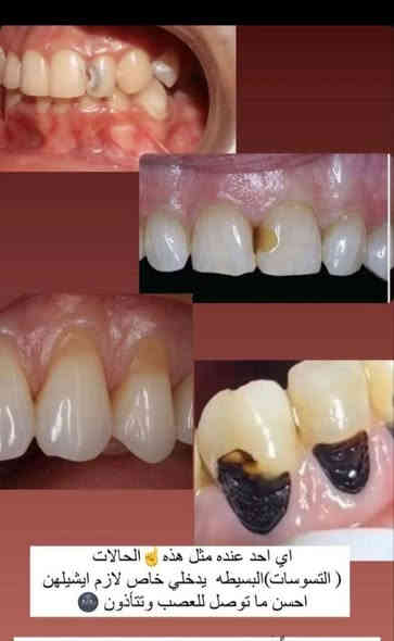 مجاناً ❗ 
- قلع الاسنان او الجذور المتبقيه 
- طقم اسنان ( تعويض الاسنان المفقوده) 
- حشوات ضوئية و معدنيه 
-تنظيف الاسنان و ازاله التكلسات 

علماً أن العلاج مجاني وتحت اشراف أطباء اختصاص
## يتوفر علاج أسنان الاطفال 

العنوان : بغداد- شارع مطار المثنى العسكري-  جامعة آشور- قرب العلاوي
@mohdt2 تلي گرام 
*********** واتساب
