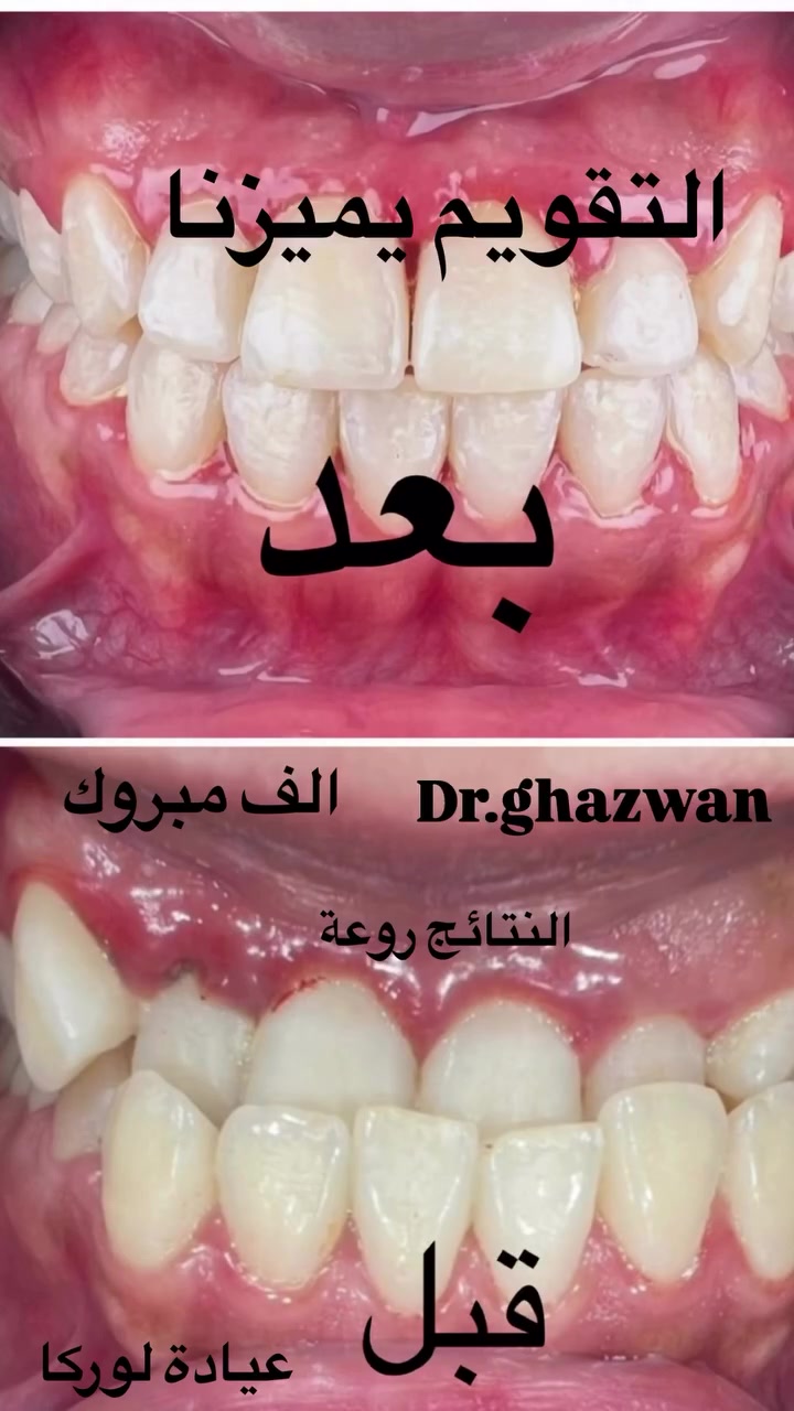 التقويم يميزنا احد اعقد و اصعب الحالات تقدم الفك السفلي ( العضة المعكوسة) يعاني من مظهر خارجي غير متناسق مشاكل اثناء تناول الطعام و الكلام عدم ارتياح اثناء النوم عض الأسنان و الخد من الداخل و مشاكل اخرى … علاج جميع حالات التقويم ضمن خطط علمية لخبرة طويلة لكثير من الحالات و نحاول تجنب المريض لمشاكل سقوط جهاز التقويم او احد عناصره … دكتور غزوان مزهر بغداد الكرخ نفق الشرطة بداية شارع الاطباء عيادة لوركا فوق صيدلية كنز النفق متوفر واتس *********** #تقويم_الأسنان_والفكين #تقويمالأسنان #تقويم_الأسنان_بأنواعه #تقويم_الشفاف_للأسنان #تقويم_الأسنان_قبل_وبعد @العضة_المعكوسة @تقدم_الفك_السفلي @العضة_العميقة @العضة_المفتوحة @زراعة_الاسنان
