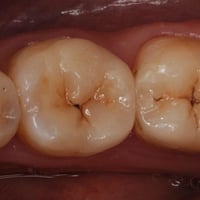 حشوة ضوئية • علاج مجاني • عيادات كلية طب الأسنان