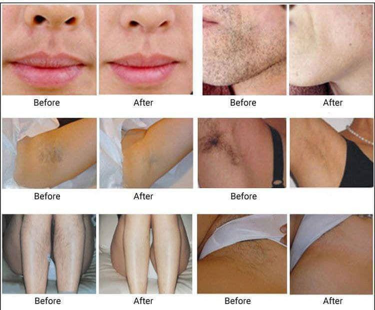 جهاز ليزر الثلجي الاصدار الجديد بقوة نص مليون ضربة
جهاز الليزر الثلجي لإزالة الشعر من ماركة ENZO الإيطالية يقدم أحدث تكنولوجيا في إزالة الشعر بشكل دائم ولا حاجة لاستخدام طرائق الإزالة التقليدية مع ميزة البرودة (الثلج) و بدقة ليزر مثالية جداً.

عمرها خساره الي متستخدمة
يكفيج ١٠ سنوات 
                          ENZO\\ (ثلجي)جهاز  الليزر 
💥جهاز ليزر لازالة الشعر💞
💥فول بدي 💞بارد...بارد...بارد..بارد
💥500 الف ومضة💞
💥يكفي ل 5 اشخاص او 10 سنوات لشخص واحد💞
💥يحتوي على عدسة  قابلة للاستبدال لازالة الشعر ونظارة البشرة💞
👆👆👆👆👆👆👆👆
الليزر المنزلي البارد 
جهاز ليزر بارد لإزالة الشعر بشكل دائم ✔ ماركة انزو الإيطالية وتخلصون من جلسات المراكز 

أحدث تكنولوجيا في إزالة الشعر بشكل دائم لا حاجة لنزع الشعر بالطرق التقليدية بعد الآن

يستخدم للوجه وكامل الجسم والمناطق الحساسة
الحل الأمثل لجميع مناطق الجسم
500 الف نبضة ضوئية  ✨
لا تسبب الألم وأكثر أماناً من الطرق التقليدية ( مثل الحلاقة أو إزالة الشعر بالحلاوة أو الشمع)
تكنولوجيا (IPL) لإزالة الشعر بصفة دائمة طريقة مثبتة طبيا
هي تكنولوجيا متطورة لإزالة الشعر بصفة دائمة عن طريق الضوء، فهي تمنح نتائج مماثلة لنتائج إزالة الشعر بالليزر في الصالونات الاحترافيّة وتستعمل بكل خصوصيّة في البيت. مناسب لكلا الجنسين ولمختلف أنواع البشرة وطبيعة الشعر
قام بإستخدام الجهاز اكثر من مليون مستخدم واثبت فعاليته
جهاز استشعار لضمان السلامة عند الإستخدام 
علاج كامل للجسم في 40 دقيقة فقط
* للحصول على أفضل النتائج يفضل إستخدام الجهاز خلال الأشهر الثلاثة الأولى مرة كل اسبوعين ، وبعد ذلك مرة كل شهر حتى تحصلين على النتيجة النهائيه
توجد نظارات للحماية من الليزر مع الجهاز
ايطالي 💯💯 بغداد, العراق


**إذا كنت صاحب هذا الإعلان وتريد حذفه لأي سبب، رجاءا أرسل رسالة إلى الدعم الفني**