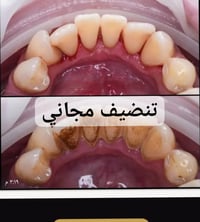 منو عنده هيج تكلسات خفيفه باسنانه ويحب يجي باجر يسويها مجاني ؟  بغداد/...