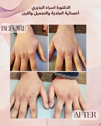 الاكزيما ما تحتاج علاج وبس تحتاج التزام بالتعليمات من الطبيب المختص . ...