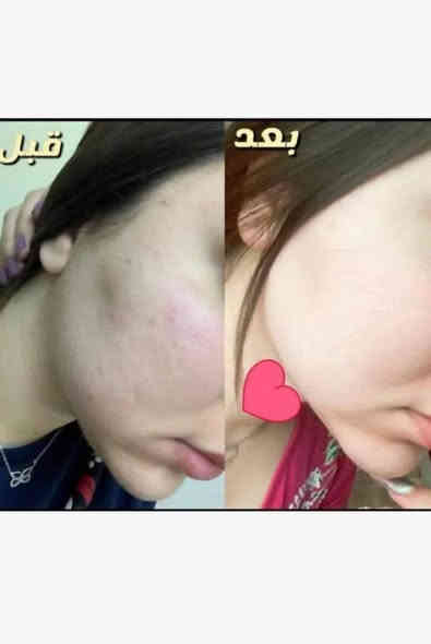 خلطه للتبيض ورفع الكلف والحبوب واسمرار البشره 🌸🌺
 وترفع الكلف والحبوب والرؤوس السوداء وبيه منفخ للخدود ڱڵـه. مواد اصليه 🌺🌺 •اللّـہ̣̥ شاهد مضبوطه ومجربه من قبل عده اشخاص وتنطي نتيجه خلال اسبوع وخاليه من درمودين واي عصارات ضاره للبشره ڱڵـه. كريمات اصليه  مبيضه تصفي البشره ترفع البقع واسمرار الشمس يوجد توصيل***********
