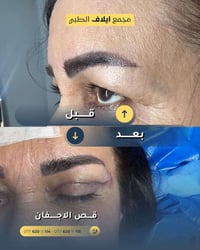 قص الأجفان • إزالة الترهل • خانقين