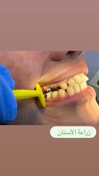 تثبيت زرعات الأسنان • بعد ٣ أشهر • النجف الأشرف