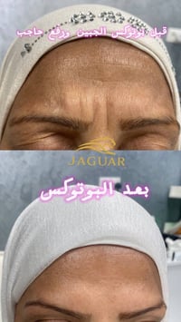 عيادة جاكوار • فلر بوتوكس • الحارثية
