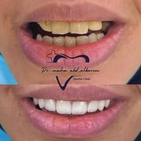 هوليود سمايل • زيركون ايماكس • الرمادي