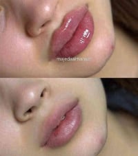 فيلر شفايف • دكتورة ماجدة • بغداد الحسينية