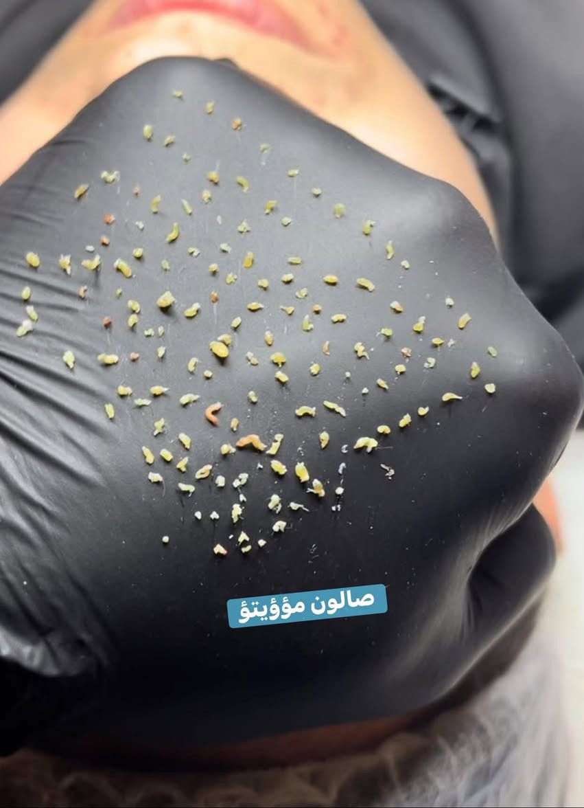 لاتخلي. بشرتك حقل تجارب 🧏🏿🧏🏻
اقوى واحدث الجلسات العالميه 🌍
ازاله الرؤؤس السوداء ومعالجتها ☑️
ازاله الدهون.   وتقليص المسام 👨🏻‍⚕️

للحجز مرسله الحساب اوالاتصال 
***********📞
العنوان. ناصريه قضاء النصر. خلف مستوصف الزهراء
