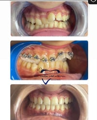 تقويم الأسنان • معالجة الأسنان المتراكمة • الرمادي شارع المستودع