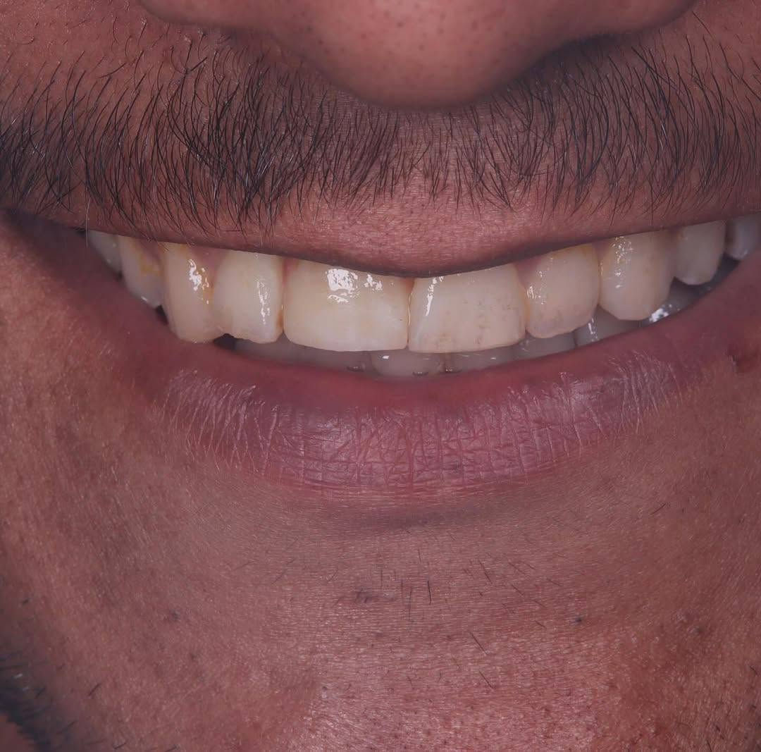 فقدت سناً؟ لا تفقد ابتسامتك!
زراعة السن الواحد هي الحل الأقرب للطبيعة لتعويض الفراغ بحل دائم، آمن، ومريح. استعد ثقتك وابتسامتك الكاملة اليوم.
احجز موعدك الآن! ***********
