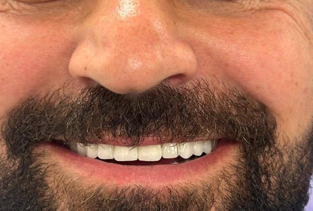 زراعة الأسنان هي الحل الأمثل لاستعادة ابتسامتك

الطبيعية بثقة وأمان ✨
مع أحدث التقنيات الطبية، نوفر لك أسنان ثابتة وقوية تشبه تماماً أسنانك الأصلية من حيث الشكل والوظيفة.
استعد راحتك أثناء الأكل والكلام، وودّع الفراغات المزعجة بابتسامة متكاملة تدوم لسنوات🦷✨
احجز موعدك الآن وابدأ رحلتك نحو ابتسامة أجمل!

متواجدين طيلة ايام الاسبوع
  نستقبلكم بكل حُب♥️
العنوان : الديوانية/ تحت الجسر المعلق / بناية فندق الديوانية سابقًا / مقابل المحافظة

للحجز والاستفسار 
***********
***********⁩
