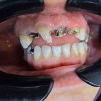 زركون أصلي • تركيب أسنان أمامية • جلستين فقط