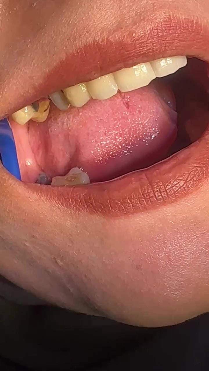 🦷✨ تجربة مراجعتنا مع زراعة الأسنان ✨🦷  

ويا الدكتور باتريك سابا  
اختصاص زراعة وجراحة الأسنان 👌  

راحة، دقة، ونتائج تعيد الثقة بابتسامتكم 🤍✨  

📍 الموقع: العزيزية – شارع الخليج – جانب البوابة  
📞 الهاتف: ***********  

مركز روح الحياة الطبي  
ابتسامتكم تبدأ من هنا ✨
