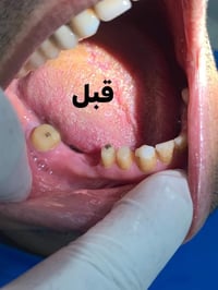 حاله اليوم تركيب اسنان ثابته للفك السفلي من خامه الزاركون . مع الرواسي...