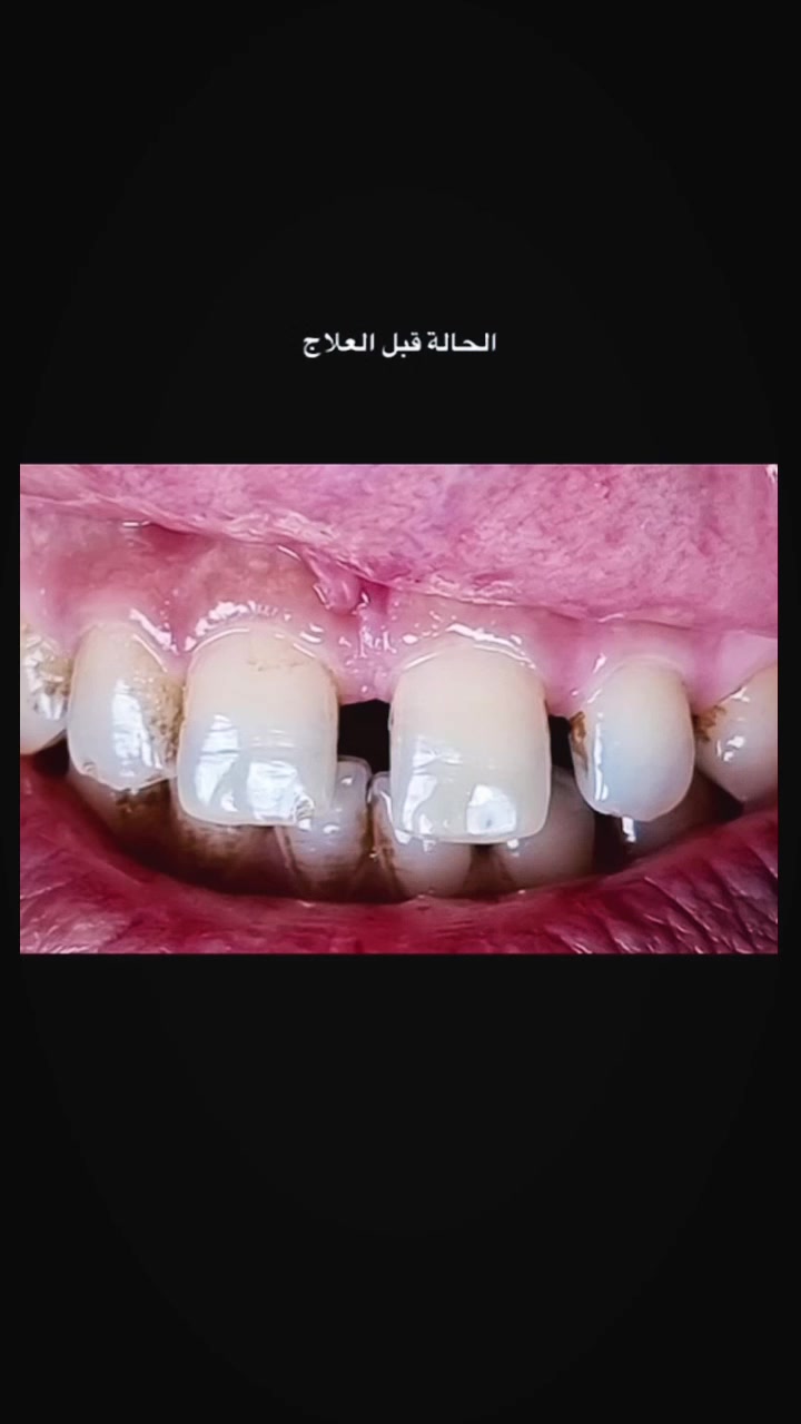 حالة معالجة الفراغات بين الاسنان  لمراجعينا الاعزاء🤩
باستخدام تلبيسات الزاركون القوييه💪
جمال وقوه وضمان😍
#الدكتور_علي_حسن_العزاوي 
بابل /جبله/شارع الاطباء مقابل مجمع التاج
للاستفسار
***********
