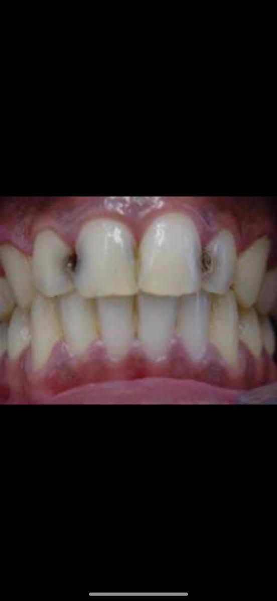 السلام عليكم  
🦷‼️
الدكتور عبدالله قاسم 
استقبل هاي الحالات :-
قلع الاسنان والجذور التالفه 
وتعويض الاسنان المفقودة بطقم جزئي
حشوات تجميلية للاسنان 
وتنظيف الاسنان وازالة التكلسات والتصبغات 
 
‼️علماً العلاج مجاني وباشراف اطباء اختصاص‼️

📍العنوان:- الكرادة_شارع 52_عيادات جامعة اوروك

  *********** 📞واتساب
