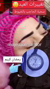 سحبة الحاجب وعين القطة بالخيوط تخدير موضعي بدون ألم و بدون جراحة ع يد ...