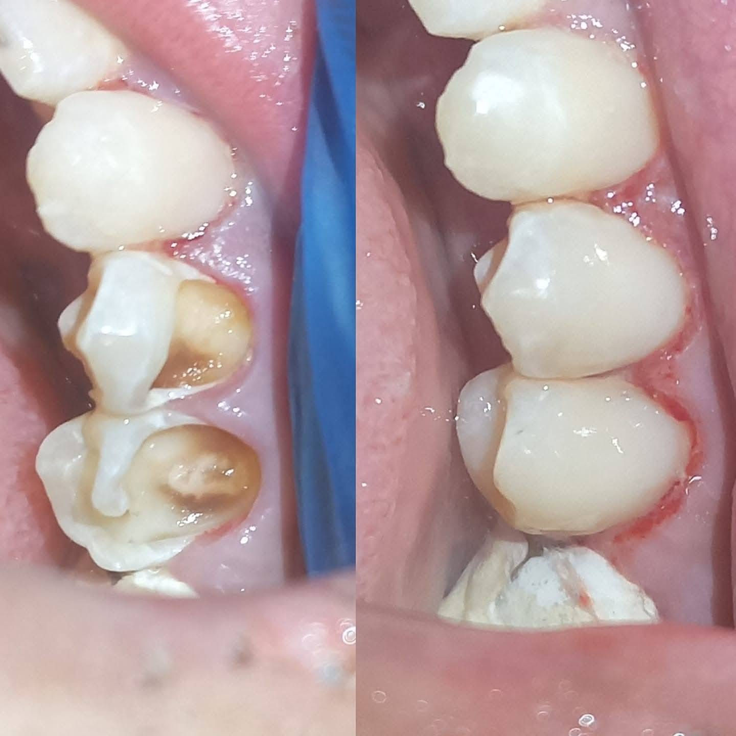 عيادة طب الاسنان الحديثة 
الدكتور علي كاظم رشيد القريشي 
حشوات ضوئية-قلع سن العقل-حشوات جذور
تنظيف و تبييض الاسنان الليزري -تركيب الاسنان الثابتة والمتحركة 
قضاء البدير-شارع الأطباء الطبي(بيت الحاج دريول) خلف مدرسة القاهرة مجاور صيدلية البديرالنموذجيه ***********
عيادة الدكتور علي كاظم القريشي لطب وزراعة وتقويم وتجميل الأسنان @إشارة
