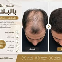 بلازما مفعلة • بيبي هير • كربلاء طويريج