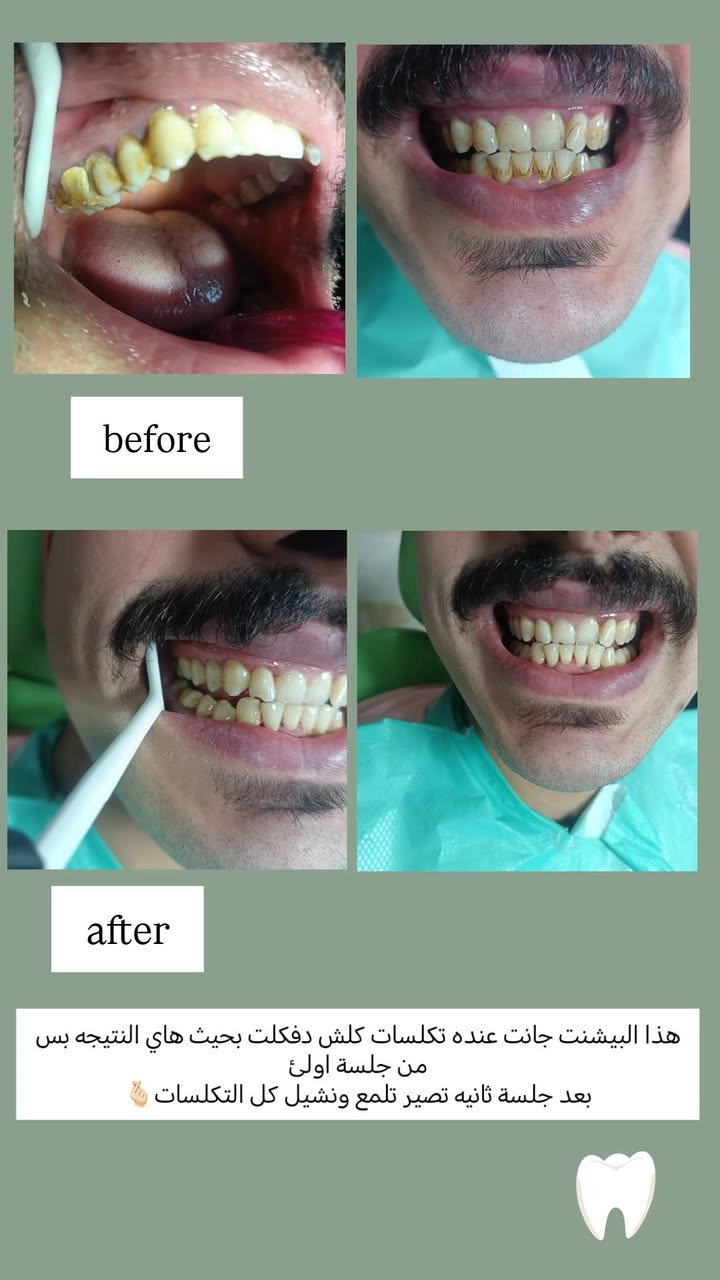 📢 إعلان لمرضى الأسنان 🦷✨
أنا طالبة طب أسنان - المرحلة الخامسة في جامعة دجلة. 
أعمل حاليًا على استقبال حالات علاجية داخل الكلية وتحت إشراف مباشر من أساتذة وأطباء متخصصين لضمان أفضل رعاية ممكنة.

🔹 تتوفر العلاجات التالية مجانًا/بأسعار رمزية (حسب نظام الكلية):

الحشوات التجميلية والعلاجية.

تنظيف الأسنان وإزالة الترسبات الجيرية.

علاج الجذور (حشوة العصب).

معالجة اللثة البسيطة.

أطقم الأسنان الجزئية والكاملة

علاج اسنان الاطفال 

✅ العلاج يتم بجودة عالية وتحت متابعة مشددة من الكادر الطبي.
✅ فرصة للاستفادة من خدمات أسنان آمنة واحترافية.

📍 المكان: الدورة - شارع المصافي / كلية دجلة الجامعة 
📞 للتواصل وحجز الحالة: ماسنجر /او عبر الرقم في الكارت


**إذا كنت صاحب هذا الإعلان وتريد حذفه لأي سبب، رجاءا أرسل رسالة إلى الدعم الفني**