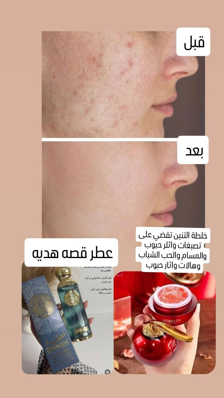 خلطة دم التنين  .

🈵تساعد على👇 
1) علاج الكلف والنمش
2 ) علاج غمقان والتهابات البشرة
3 ) تفتيح الوجه وتعالج حروق الشمس
4 ) علاج بثور الوجه والدهون الزائدة
5 ) ممتازة جدا جدا للبشرة الحساسة 👍
6 ) ترطب وتعطي نعومة فائقة للبشرة .
السعر عرض حاليا((6الف فقط)) 
الحجز والاستفسار التواصل خاص
لايك وفولوا للبيج 🫶🏻🥹🌷
#عناية_بالبشرة #روتين_العناية #منتجات_عناية #نضارة_طبيعية #عناية_يومية #منتجات_مضمونة #جمالك_طبيعي #اكسبلور #سكن_كير بغداد, العراق


**إذا كنت صاحب هذا الإعلان وتريد حذفه لأي سبب، رجاءا أرسل رسالة إلى الدعم الفني**