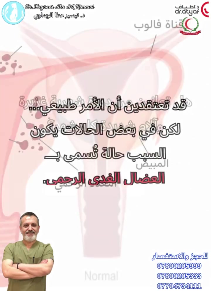 هل تعانين من آلام شديدة أثناء الدورة الشهرية أو نزف غزير يتكرر كل شهر؟

قد لا يكون الأمر طبيعيًا كما تعتقد كثير من النساء…

في هذا الفيديو نسلّط الضوء على حالة شائعة تُسمى "العضال الغدي الرحمي"، والتي قد تكون سببًا خفيًا وراء الألم المزمن، غزارة الدورة، وأحيانًا تأخر الحمل.

التشخيص المبكر يساعد على تحسين جودة الحياة واختيار العلاج المناسب 🌷

الدكتور تيسير عطا الريماوي 🥼
العنوان: العراق🇮🇶 بغداد_مستشفى الجادرية الاهلي الطابق الرابع _مركز الدكتورة أطياف للعقم وأطفال الأنابيب 
للحجز والاستفسار 
***********📲
***********📲
***********📲
#الدكتور_تيسير_عطا_الريماوي
#العضال_الغدي_الرحمي
#Adenomyosis
#آلام_الدورة
#غزارة_الدورة
#تأخر_الحمل
#صحة_المرأة
