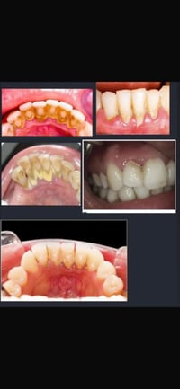 تنظيف اسنان مجاناً لفتره محدوده للحجز خاص او على الرقم 07762180563