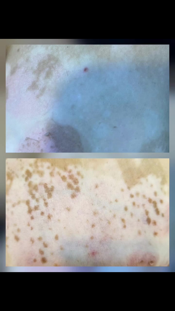 "شنو معنى ظهور نقاط غامقة داخل بقع البهاق؟".
يُعد علامة إيجابية على استجابة الجلد للعلاج وبدء عودة الصبغة الطبيعية 🤍
هذه النقاط تظهر غالباً داخل البقعة أو حول بصيلات الشعر وتزداد تدريجياً مع الاستمرار بالعلاج 📈
الالتزام بالعلاج والمتابعة هو سر الحصول على نتائج أفضل بإذن الله 🌿

الدكتورة هدى محي الدين رشيد
اخصائية الامراض الجلدية والتجميل والليزر
حويجه_مجمع الوارث- مقابل محلات الحمداني
للحجز والاستفسار
***********

#حويجه #بهاق
