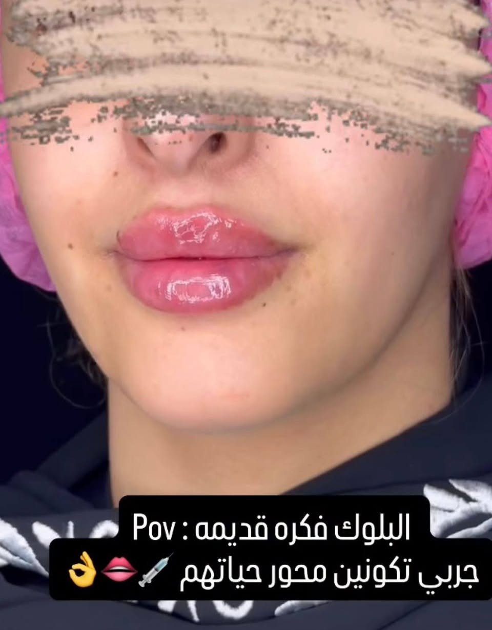 تحت إشراف الدكتورة [حنين الصراف] نقدم لكم أحدث تقنيات الحقن التجميلية بأعلى معايير الأمان والدقة للحصول على نتائج طبيعية تبرز جمالكِ الحقيقي دون مبالغة.
💎 بوتوكس 💎 فيلر الشفاه والخدود 💎 تحديد الكونتور والفك 💎 جلسات النضارة والترطيب العميق 💎 استشارات تجميلية متخصصة
✔️ خبرة واحترافية ✔️ مواد أصلية ومعتمدة ✔️ نتائج طبيعية تليق بجمالكِ
الدكتورة حنين الصراف 
كوني النسخة الأجمل من نفسكِ... فالجمال الراقي يبدأ مع الاختيار الصحيح. ✨🤍

💖  عنوان الجمال الراقي للسيدات
#تجميل #بوتوكس #فيلر #نضارة_البشرة #جمال_راقي #كوت

ورابط صفحة الطبيبة على الانستكرام:- 
‏https://www.instagram.com/dr_haneen_alsaraf/

رابط صفحة الطبيبة على الفيسبوك:- 
‏https://www.facebook.com/Haneenclinic1?mibextid=ZbWKwL

عنوان الطبيبة 
https://maps.apple/p/N9-Xe99xRLrvZf

📍 العنوان:- | العراق | الكوت | شارع الهورة | بناية ابن فنجان | مجمع الطبيب الجراح | الطابق الثاني

📞 للحجز والاستفسار:- 
***********
📞 ***********
📞 ***********
💖  عنوان الجمال الراقي للسيدات
#تجميل #بوتوكس #فيلر #نضارة_البشرة #جمال_راقي #كوت
تحت إشراف الدكتورة [حنين الصراف] نقدم لكم أحدث تقنيات الحقن التجميلية بأعلى معايير الأمان والدقة للحصول على نتائج طبيعية تبرز جمالكِ الحقيقي دون مبالغة.
