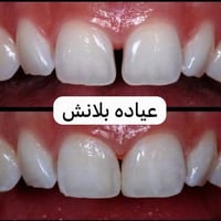 غلق الفراغات بين الأسنان بدون الحاجة إلى برد الأسنان بجلسة واحدة 🦷✨ 📞ل...