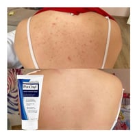 علاج حب الشباب • تنظيف المسام • توصيل لكل المحافظات