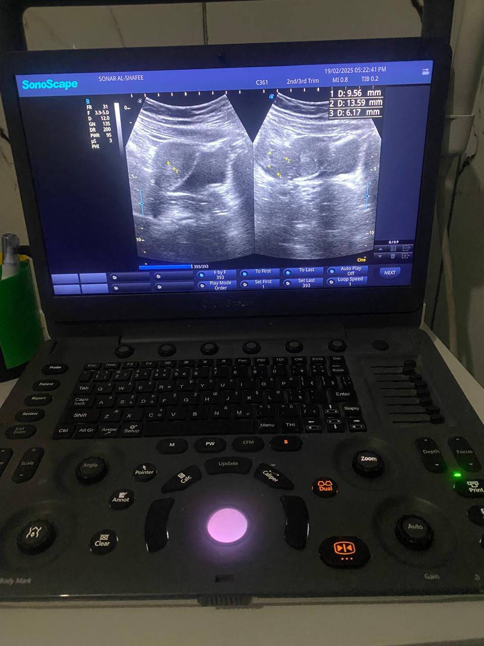 جهاز سونار نوع سونو سكيب نوع E1  بروبين باطني وداخلي نسائي موديل 2020 نظافه 98‎%‎ استخدام قليل للبيع مع طابعة الصور السونار نوع سوني وجهاز شحن اصلي للاستفسار واتساب ***********
