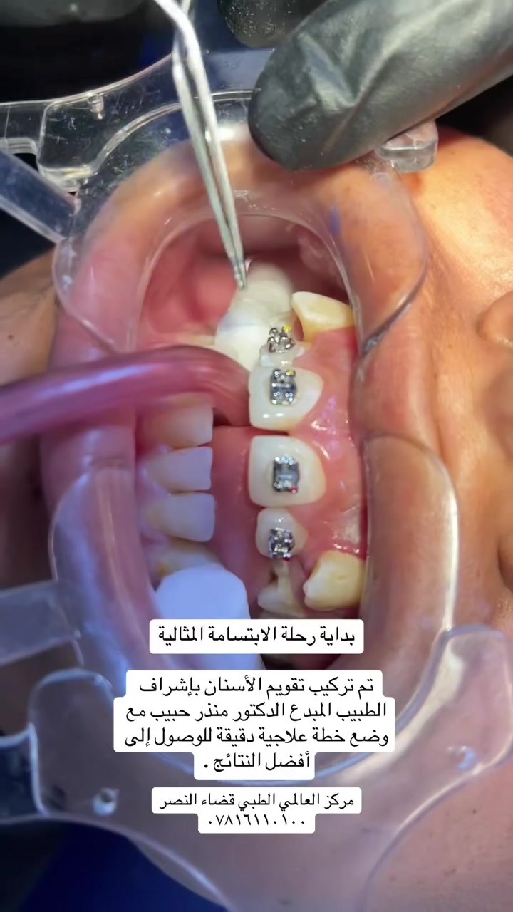 بداية رحلة الابتسامة المثالية
تم تركيب تقويم الأسنان بإشراف الطبيب المبدع الدكتور منذر حبيب مع وضع خطة علاجية دقيقة للوصول إلى أفضل النتائج .

المركز العالمي الطبي الخيري السوري قضاء النصر الصوب الكبير الفرع المقابل مصرف الرافدين

الاستفسار ***********
