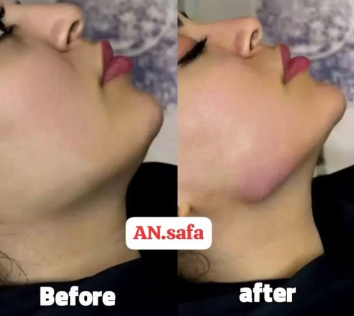 🎆 عرض رأس السنة الخيــالي 🎆🎉
💫 آخر يوم بالسنة – لا يفوتج 💫
💆‍♀️💉 جلسات الميزوثيرابي للوجه
✨ الجلسة الواحدة: 25 ألف 💰
✨ جلستين فقط: 35 ألف بدل 50 ألف 🔥
💖💎 العروض تشمل:
🌸 علاج حب الشباب + آثار وندب ✨ 35 ألف
🌸 كلف البشرة + تفتيح وتوحيد اللون 🤍 35 ألف
🌸 ميزو هالات إسباني 👁️ + ميزو نضارة ✨ 35 ألف
👩‍⚕️💉 جميع الجلسات داخل الصالون
🌟 على يد خبيرة التجميل اللاجراحي
AN SAFA 🌟
📌⏰ الحجز مسبقاً إلزامي
📩 احجزي من خلال بريد الصفحة
📞 أو عبر الأرقام الموجودة
***********
العنوان سويب ال ٢٠٠ محلات عماد الساعدي 

🔥✨ استقبلي السنة الجديدة ببشرة تجنن، ناعمة ومضيئة ✨🔥
💄💋 الأماكن محدودة… سارعي بالحجز 💕
