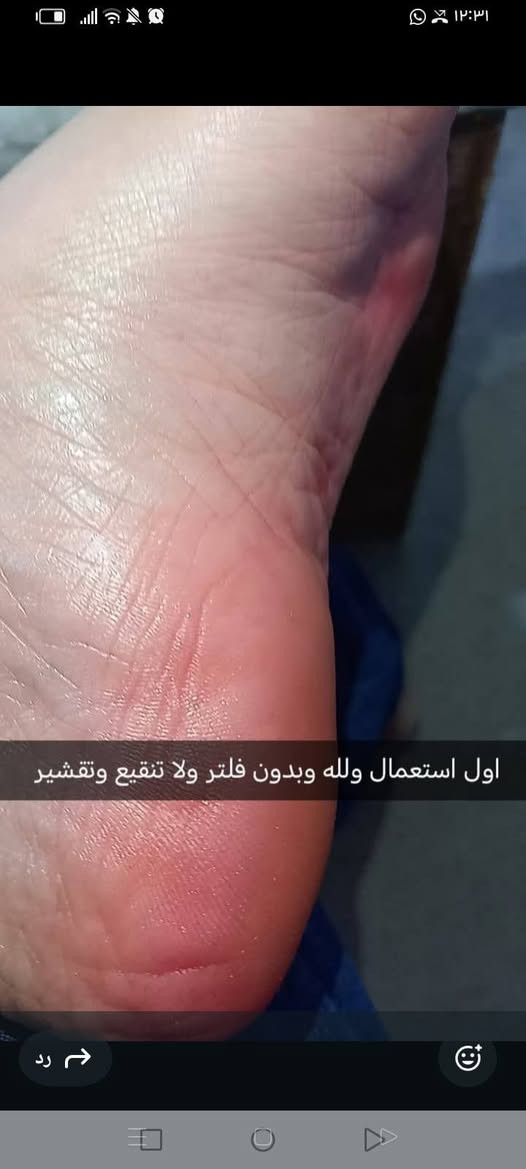 لا تقصرون برفع الصفحه متعطله ❤️
بنات بس ب5 الف عافيه تخلين قدمج يضوي مرجوع فقط من أول استعمال يجنننن بالصيف اكيد تشققات وخشونه شرط مليان زيوت عشبيه وزبدات وكريمات مغذيه ترمم جلد من الداخل وتسوي القدم ناعممم وردي خفيف وحت من فوك ينطي تفتيح ويسوي الاضافر وردي عبالك بيبي حجم كبير يكفيج شهرين


**إذا كنت صاحب هذا الإعلان وتريد حذفه لأي سبب، رجاءا أرسل رسالة إلى الدعم الفني**