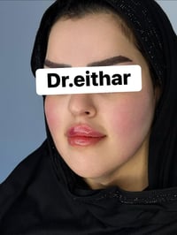 شد الوجه • فلر الشفة • الكوت الهوره