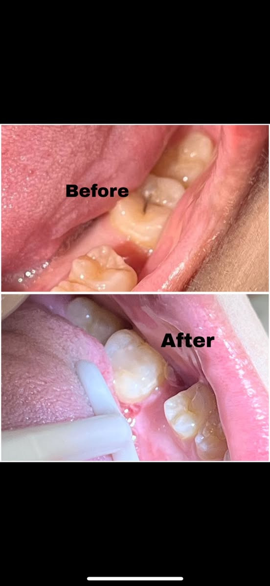 الي محتاج تنظيف اسنان او حشوات او تعويض اسنان بطقم متحرك يراسلني ع الواتساب  والشغل مجاناً 
***********
