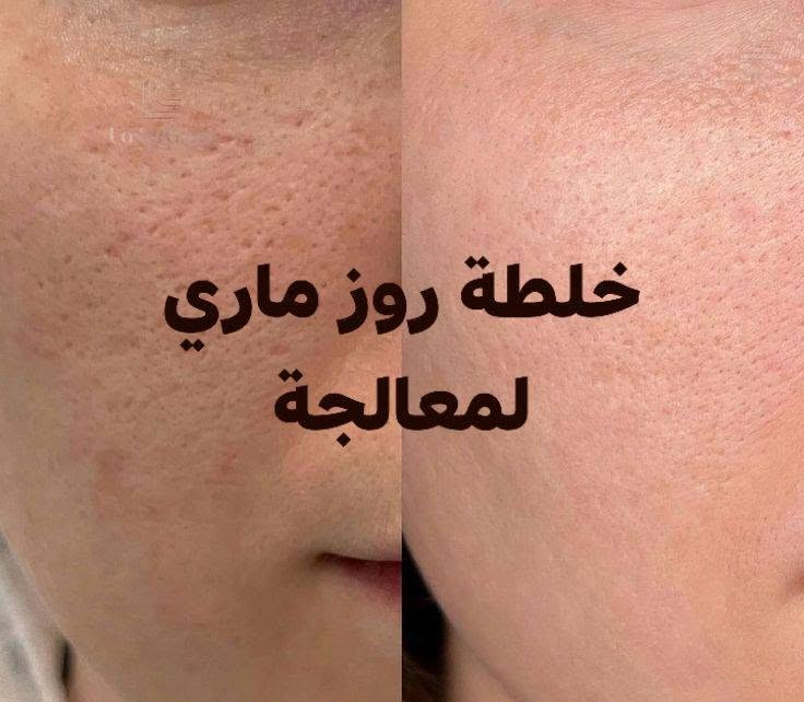 خلطة روز ماري لمعالجة
سعر 10امانة الله مابيها عصارات فقط كريمات وفيتامنيات


**إذا كنت صاحب هذا الإعلان وتريد حذفه لأي سبب، رجاءا أرسل رسالة إلى الدعم الفني**