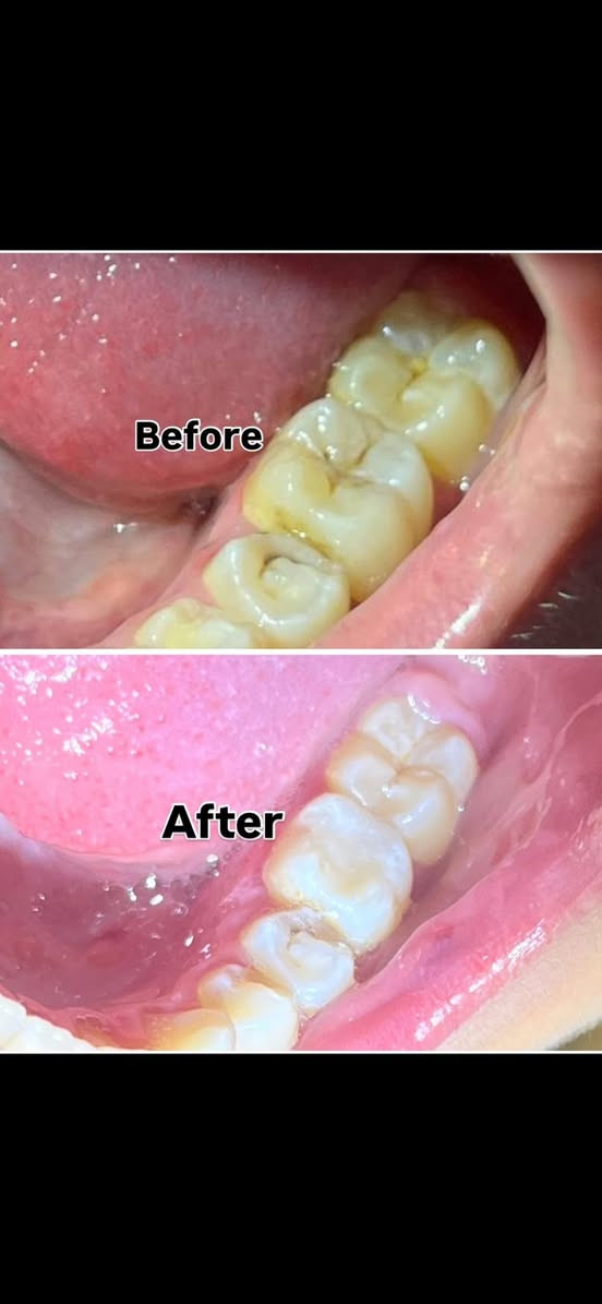 الي محتاج تنظيف اسنان او حشوات او تعويض اسنان بطقم متحرك يراسلني ع الواتساب  والشغل مجاناً 
***********

