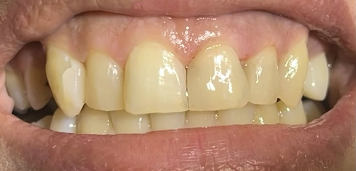 عيادة الطائي لطب الاسنان ♥️

حشوات تجميلية بأجمل صورة باستخدام مواد رصينة والوان الحشوات القريبة على الاسنان ✅

للحجز *********** واتس اب 

أو على الرقم *********** 

عيادة الطائي لطب الاسنان

#سبعالبور
#التاجيات
#التاجي
#سبع_البور
