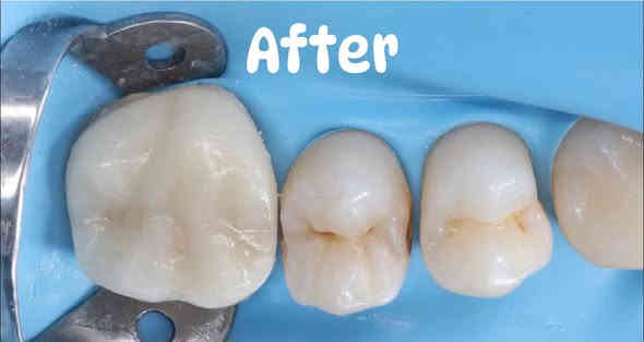 👏عيادة أسنان في مجمع اليسر الطبي 👏
استبدال حشوة معدنية متسوسة باخرى ضوئية 
وارجاع السن الى شكله ووظيفته الطبيعية

📍العنوان (شهداء البياع / بداية شارع المضخة / بجانب مستوصف الشهداء )

📍للحجز و أستفسار (***********)
