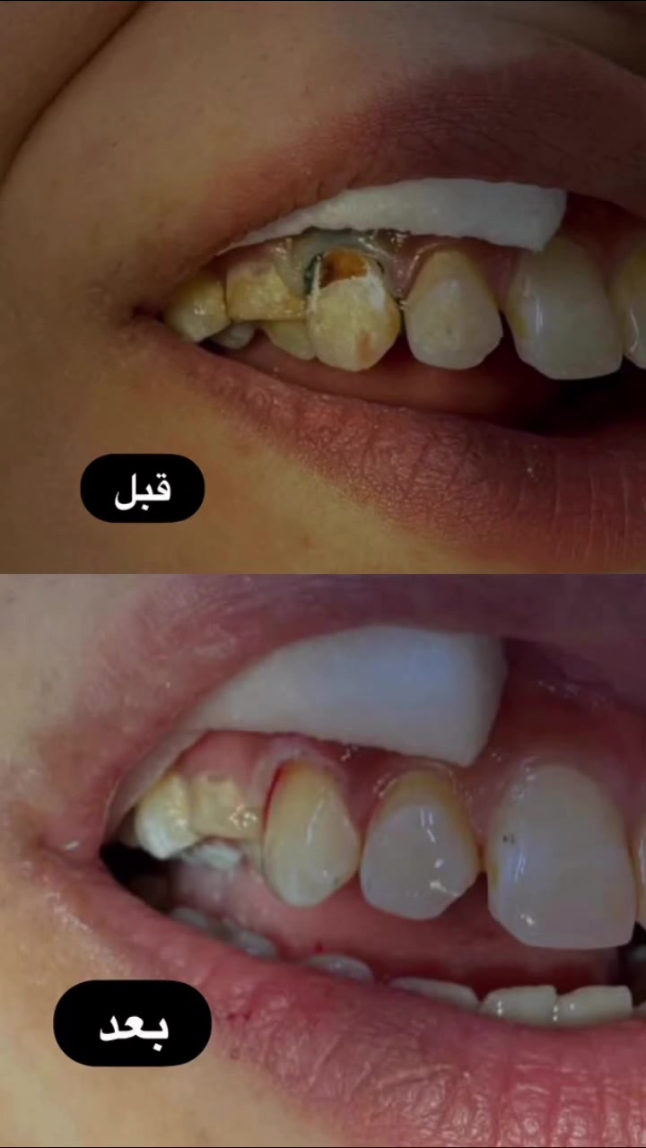 قبل وبعد ترميم السن بحشوة تجميلية
📍 د. فاطمة
متواجدة في واسط الحفرية عيادة الدكتورة اسراء مقابل ولاء للتصوير 
للحجز والاستفسار  
***********
